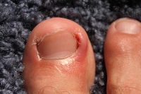 Causes and Risks for Ingrown Toenails