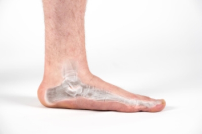 Treatment for Adult Acquired Flat Feet