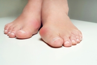 Causes and Risk Factors for Bunions