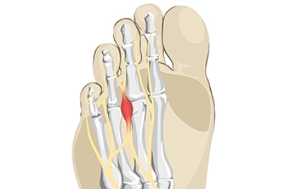 Facts About Morton’s Neuroma