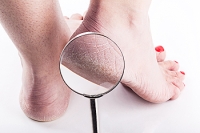 Causes of Cracked Heels During Pregnancy