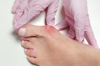 Deciding on Bunion Surgery